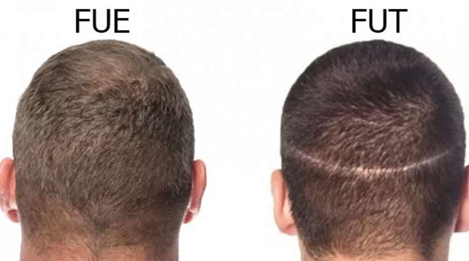 FUE-method-Iran