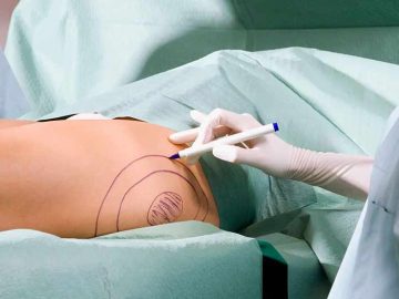 body-contouring-in-Iran