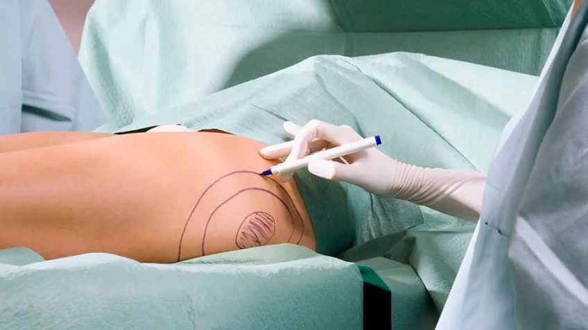body-contouring-in-Iran