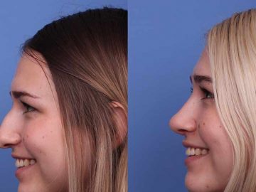 Iran-nose-surgery