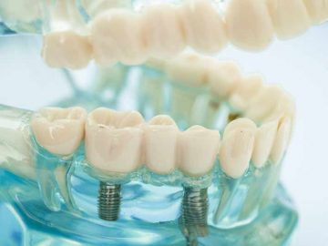 dental-implant-cost-Iran