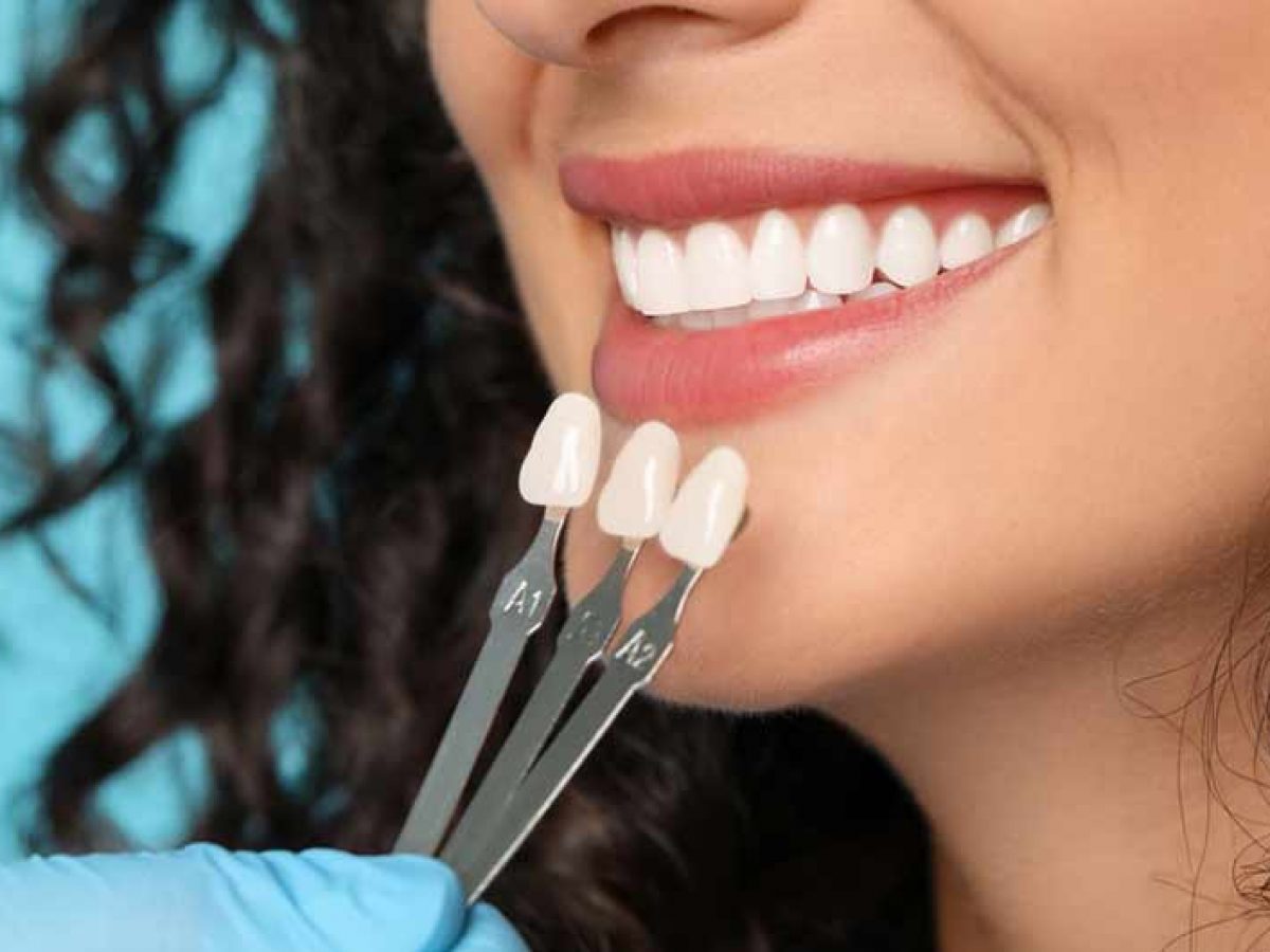 dental-implants-in-Iran