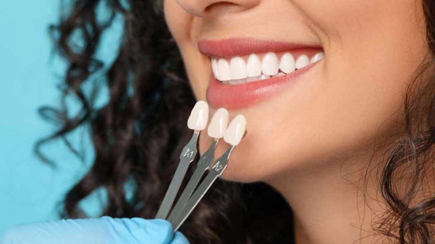 dental-implants-in-Iran