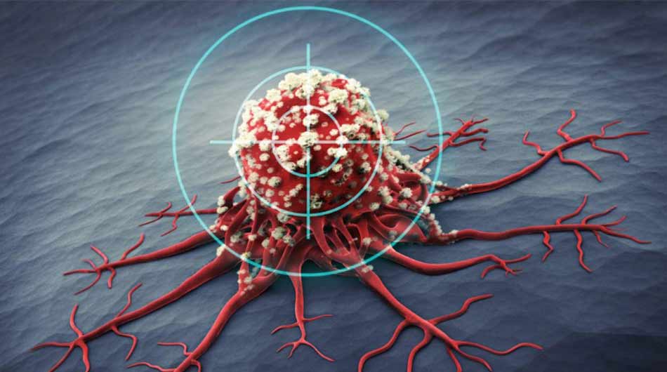 Cancer-treatment-in-Iran