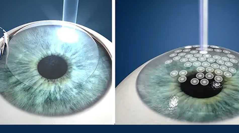 LASIK-in-Iran