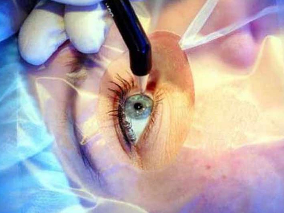 eye-surgery-in-Iran