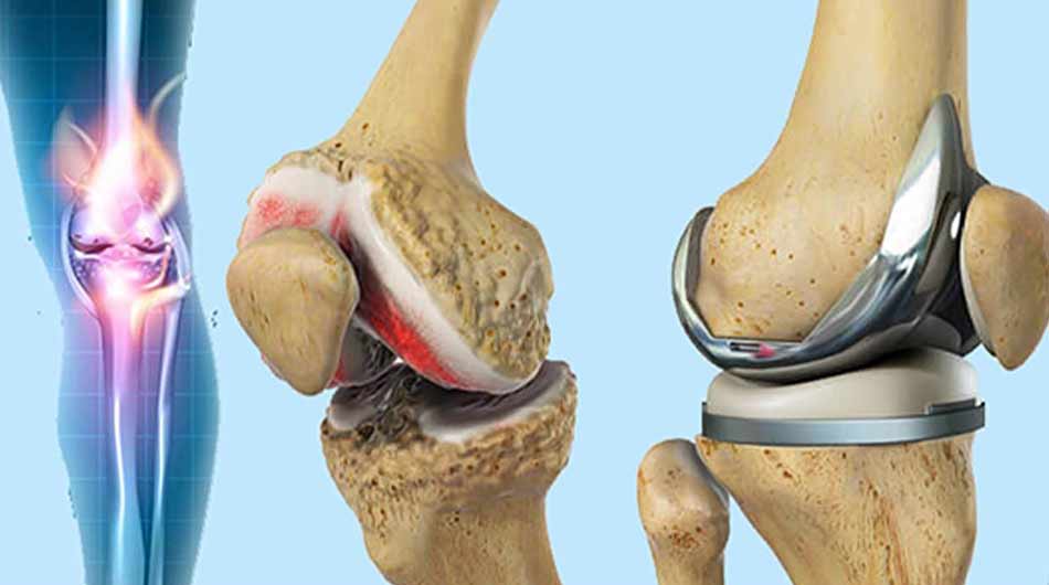 joint-replacement-Iran