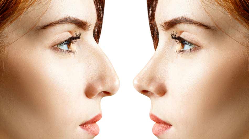 rhinoplasty-in-Iran